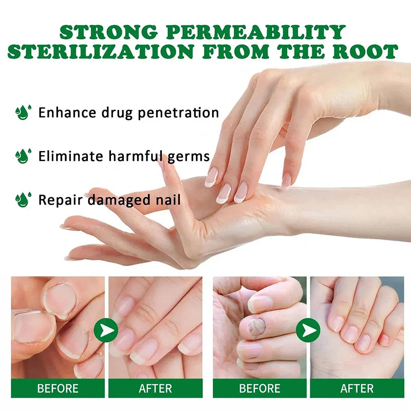 Extra Strong Nail Fungus Treatment Serum Essence oil Feet Nails Repair Care Essence Cream Anti Infection Toe Fungal Removal